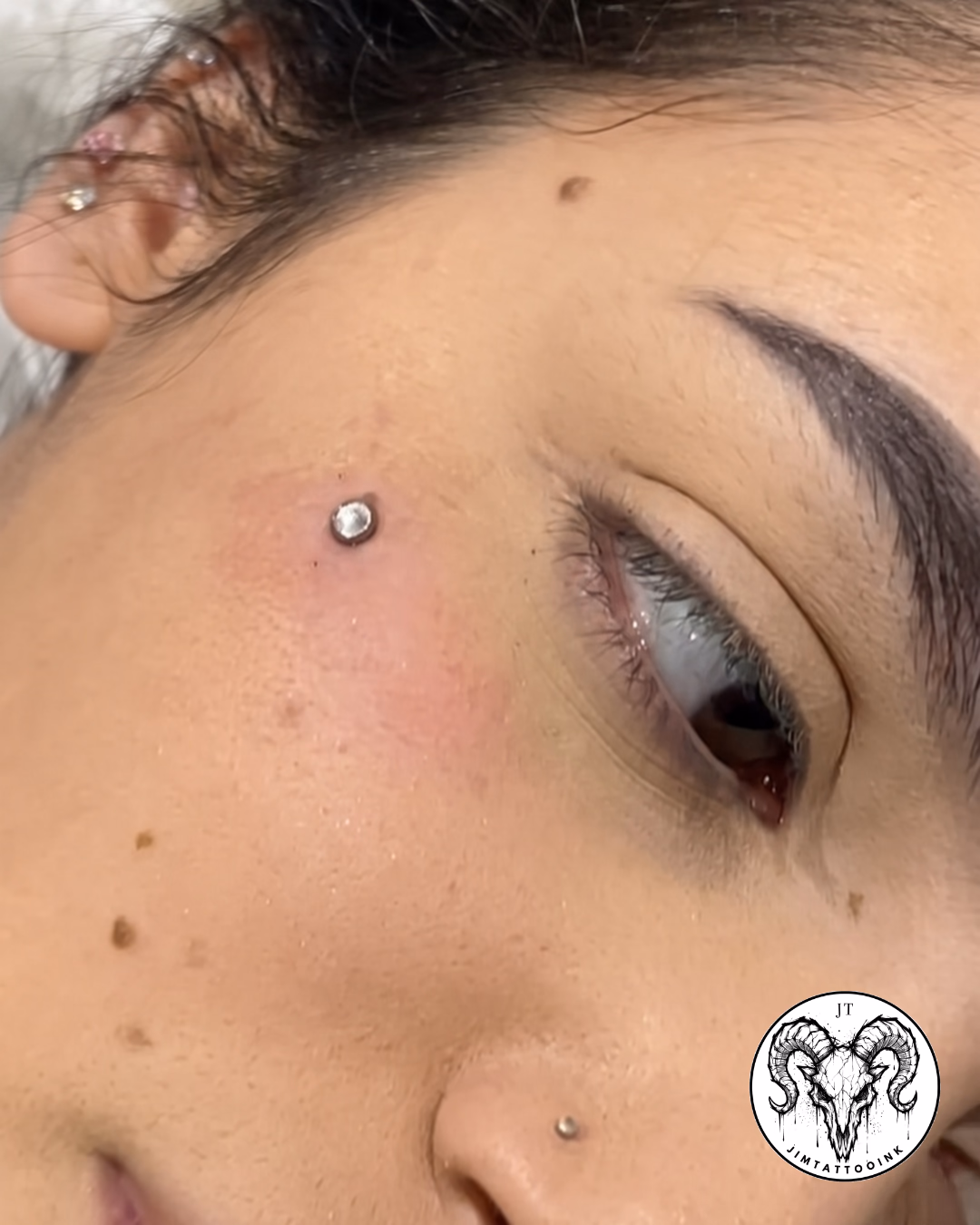 Microdermal facial